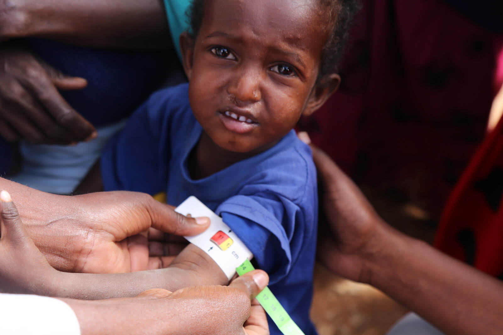Ein Junge in Somalia wird mit medizinischer Hilfe versorgt.