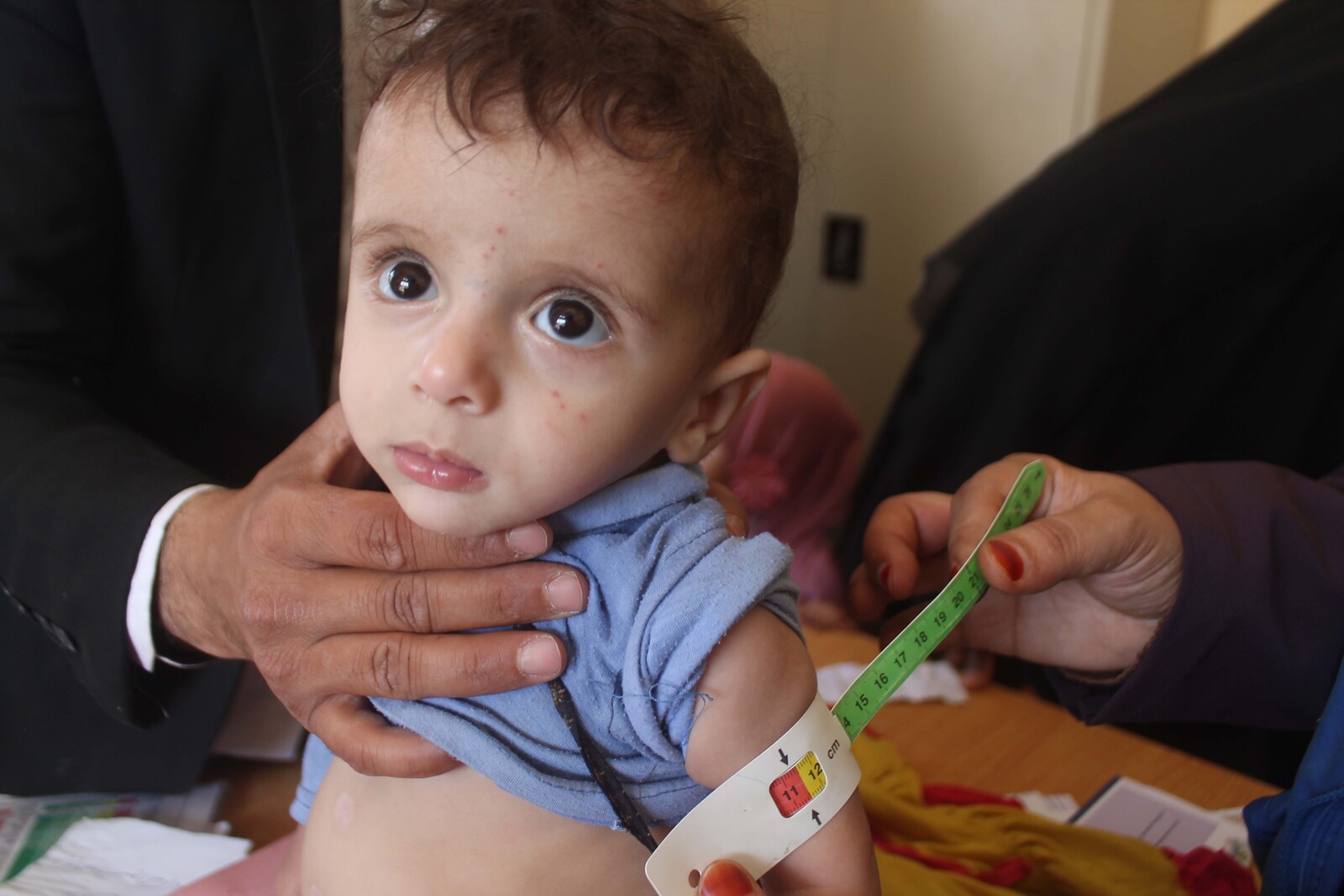 Einem Kind im Jemen wird mit dem Hungermaßband der Arm vermessen