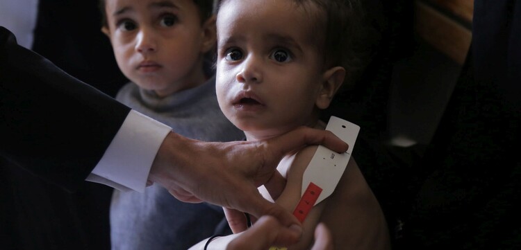 Ein kleines Kind mit Hungermaßband: Es leidet an Unterernährung und Cholera Ein kleines Kind mit Hungermaßband: Es leidet an Unterernährung und Cholera