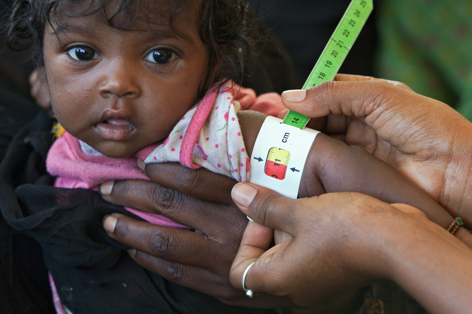 Einem kleinen Mädchen wird während der Hungersnot in Äthiopien der Oberarm gemessen