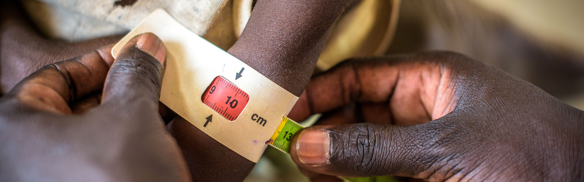 Ein Kind im Südsudan: Das Hungermaßband zeigt Rot