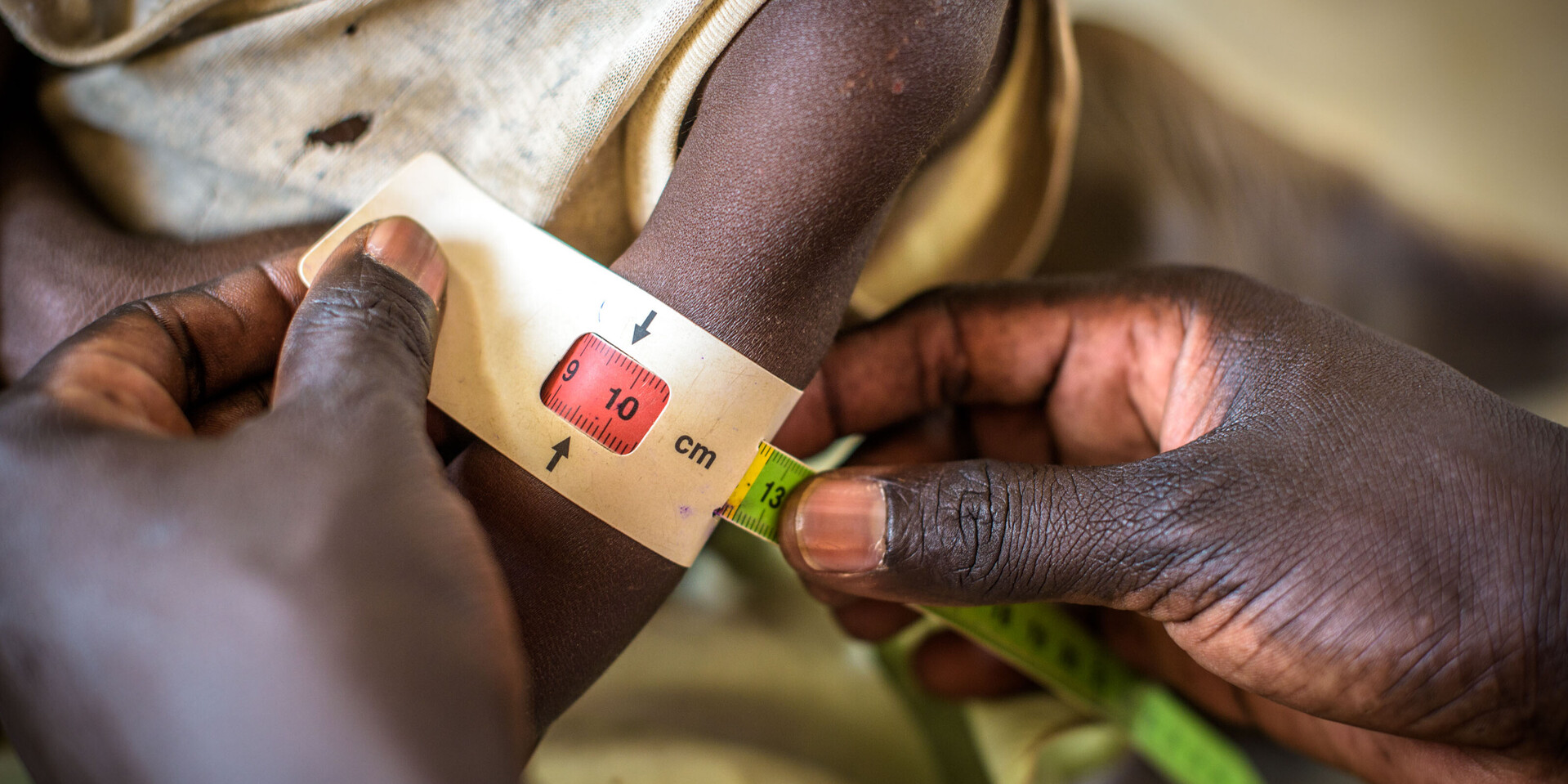 Ein Kind im Südsudan: Das Hungermaßband zeigt rot