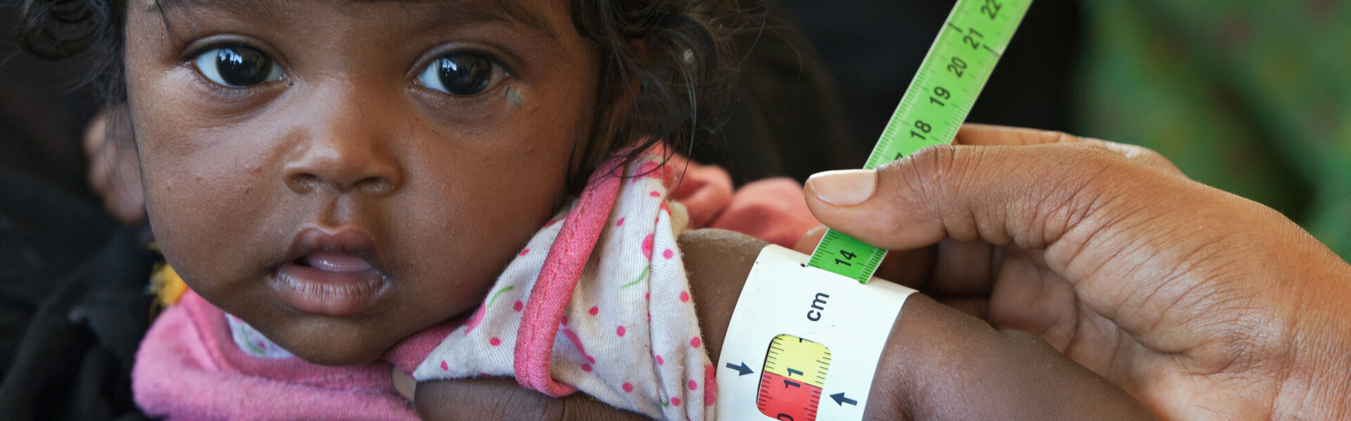 Einem Baby in Äthiopien wird der Arm mit einem Hungermaßband abgemessen (Archivbild)