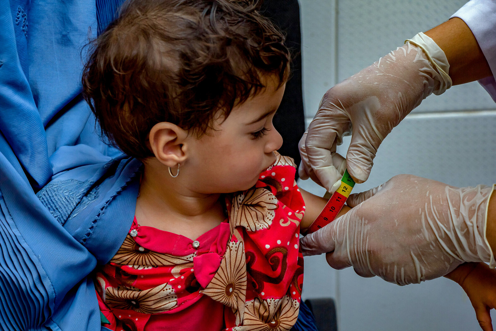 Ein Arzt misst mit einem Hungermaßband den Grad der Unterernährung bei einem kleinen Mädchen in Afghanistan