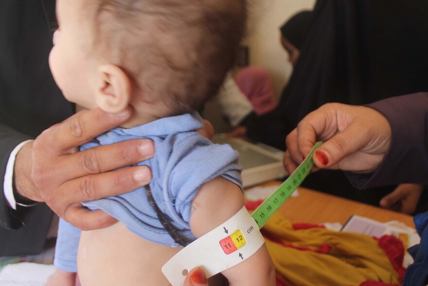 Ein Helfer misst das dünne Ärmchen eines mangelernährten Kindes im Jemen Ein Helfer misst das dünne Ärmchen eines mangelernährten Kindes im Jemen