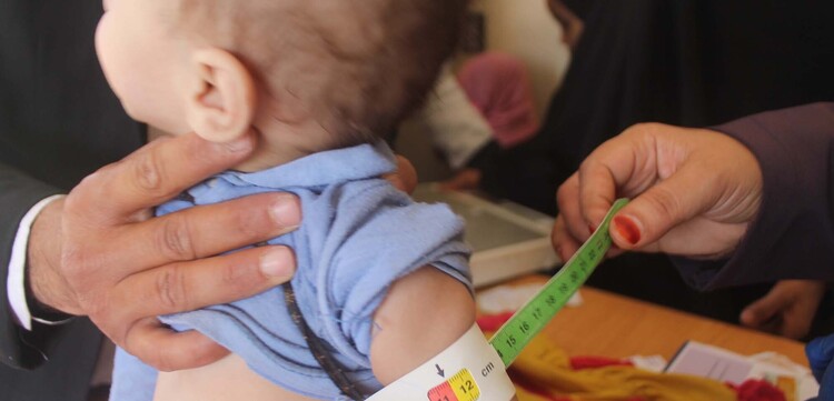Ein Helfer misst das dünne Ärmchen eines mangelernährten Kindes im Jemen Ein Helfer misst das dünne Ärmchen eines mangelernährten Kindes im Jemen