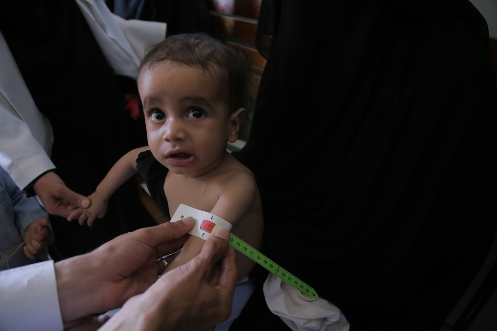 Ein unterernährtes Kind im Jemen wird von Ärzten untersucht.