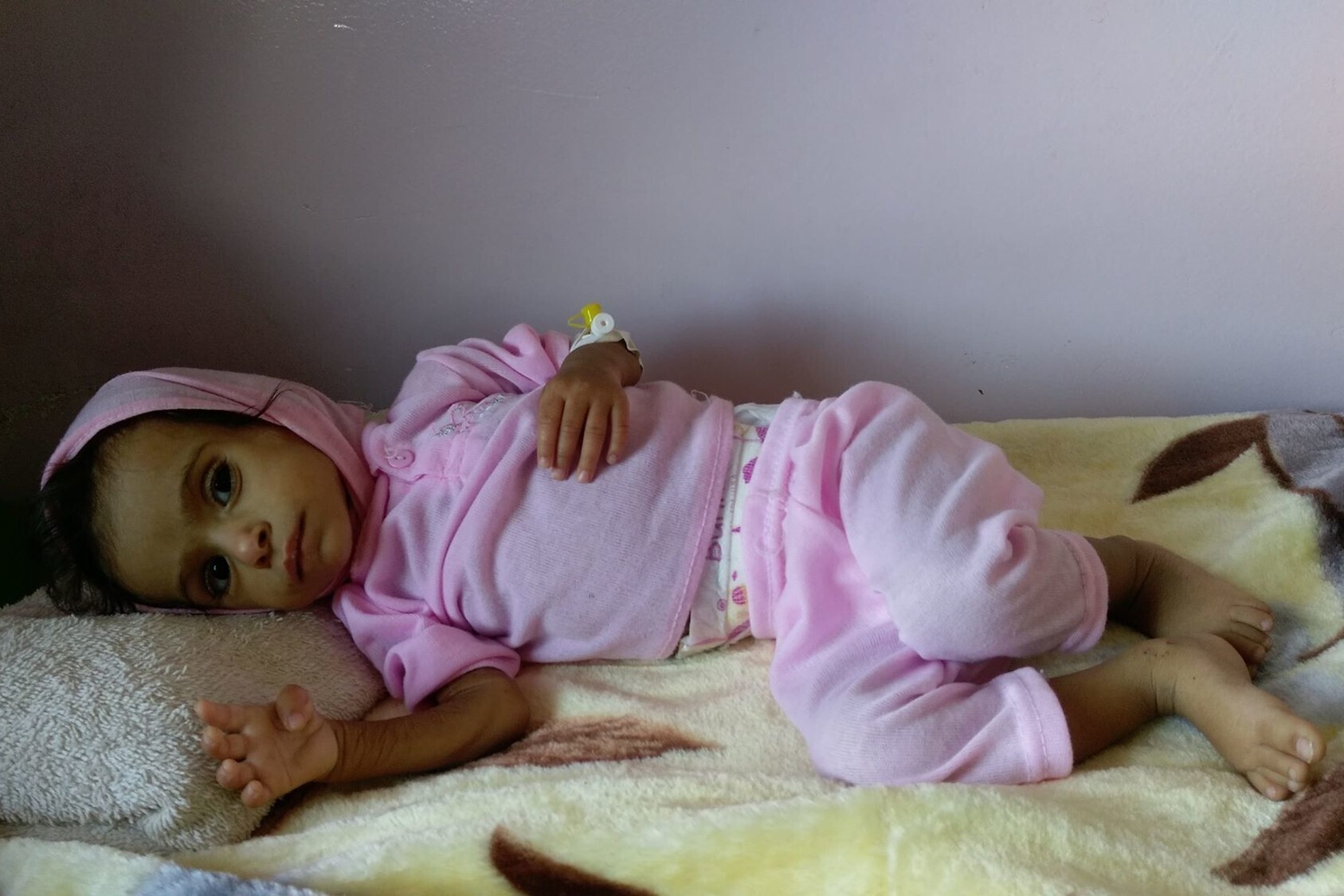 kleines unterernährtes Mädchen liegt auf einer Wolldecke in einem Krankenhaus im Jemen