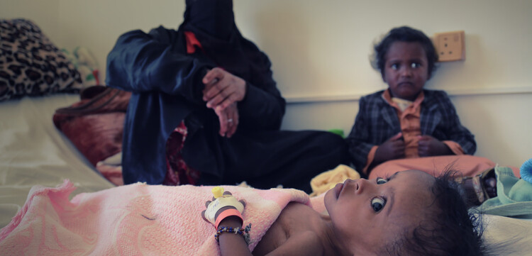 Ein an Cholera erkranktes Kind im Jemen Ein an Cholera erkranktes Kind im Jemen