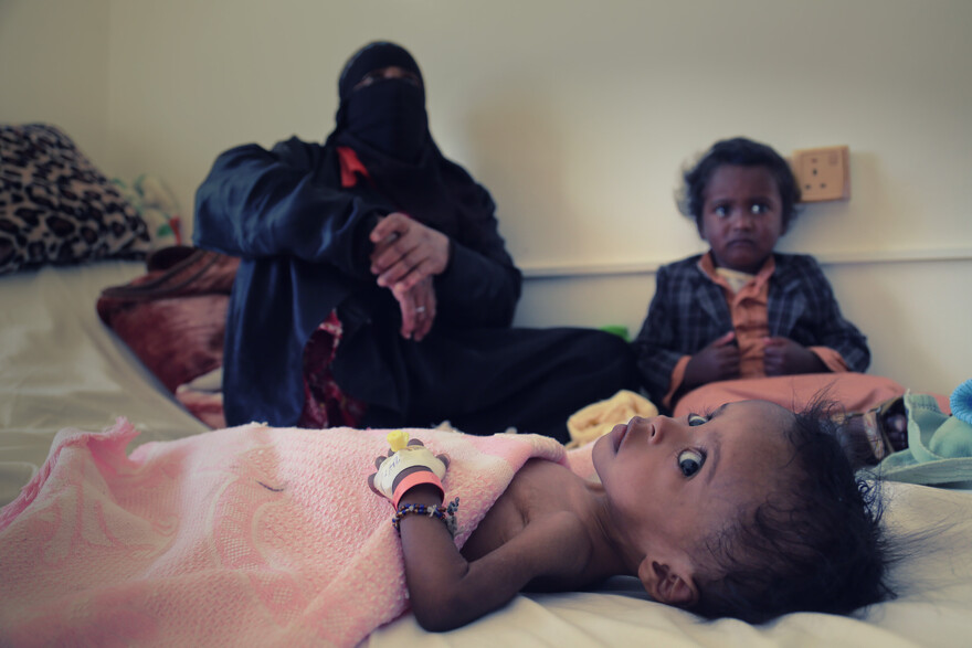 Ein an Cholera erkranktes Kind im Jemen Ein an Cholera erkranktes Kind im Jemen