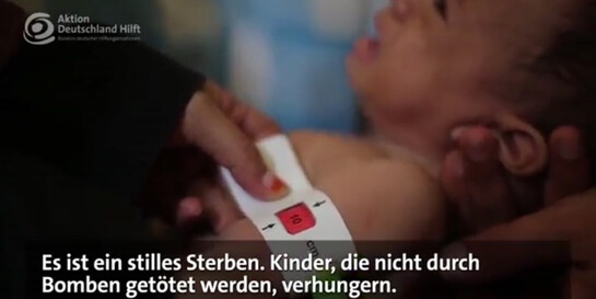 Ärzte versorgen ein unterernährtes Kind im Jemen.