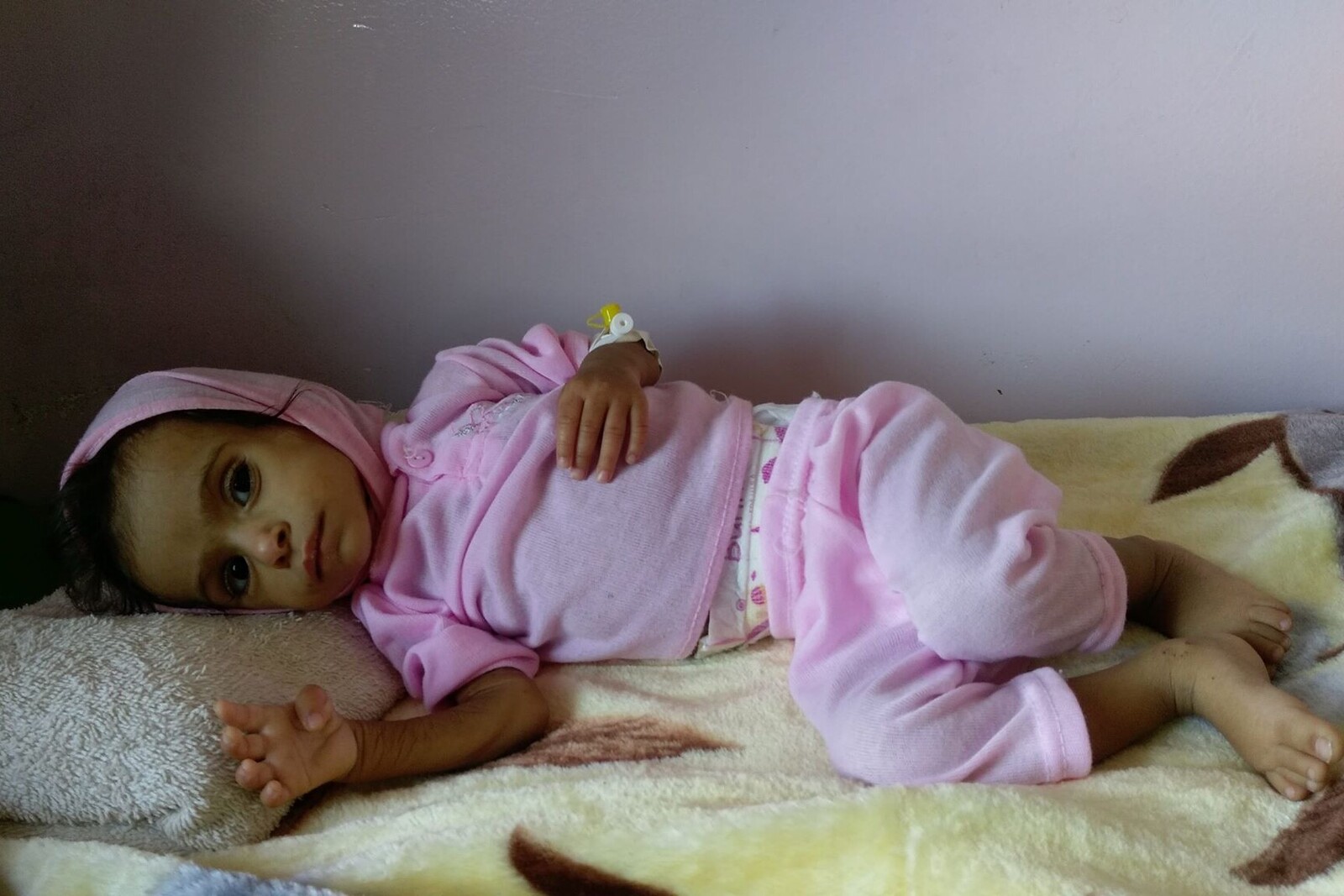 Ein unterernährtes Baby im Jemen