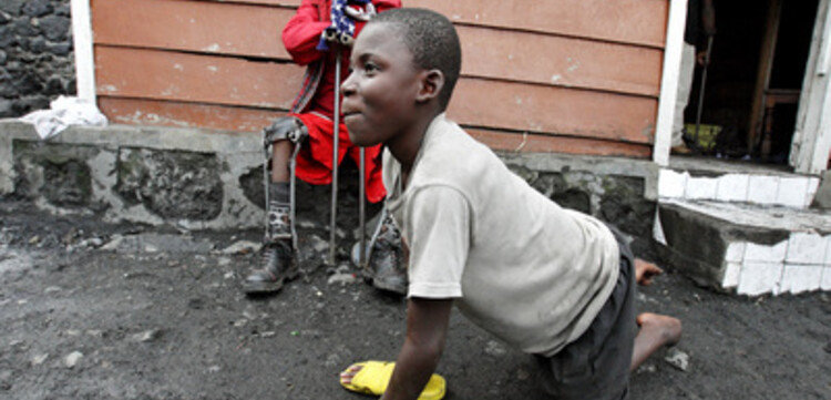 Kongo: 2 Kinder mit kinderlähmung