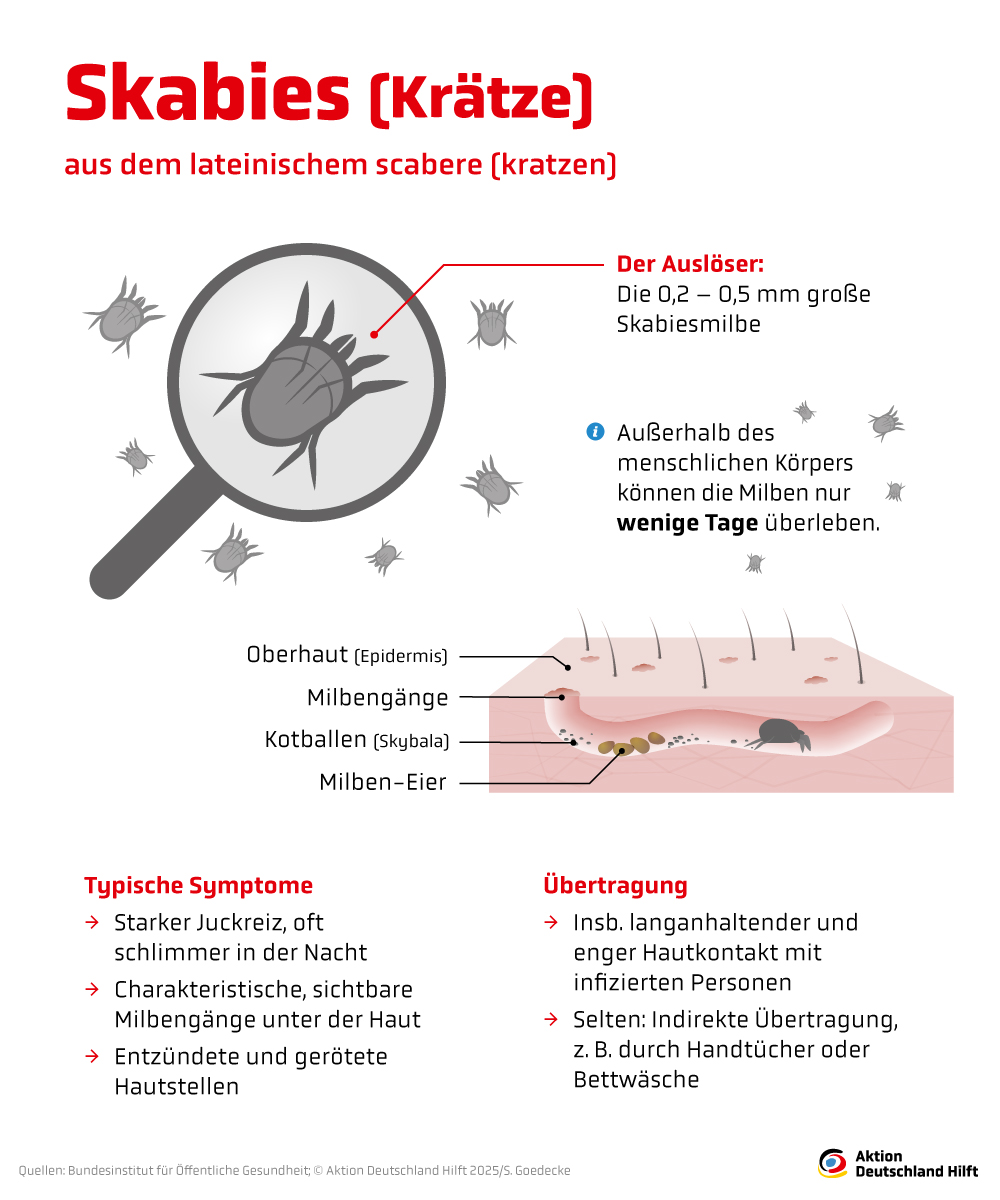 Skabies/Krätze: Symptome und Ursachen